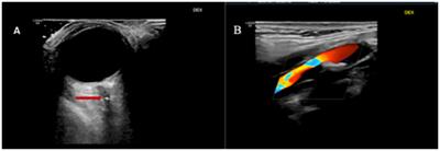 Central retinal artery occlusion or retinal stroke: a neurosonologist’s perspective